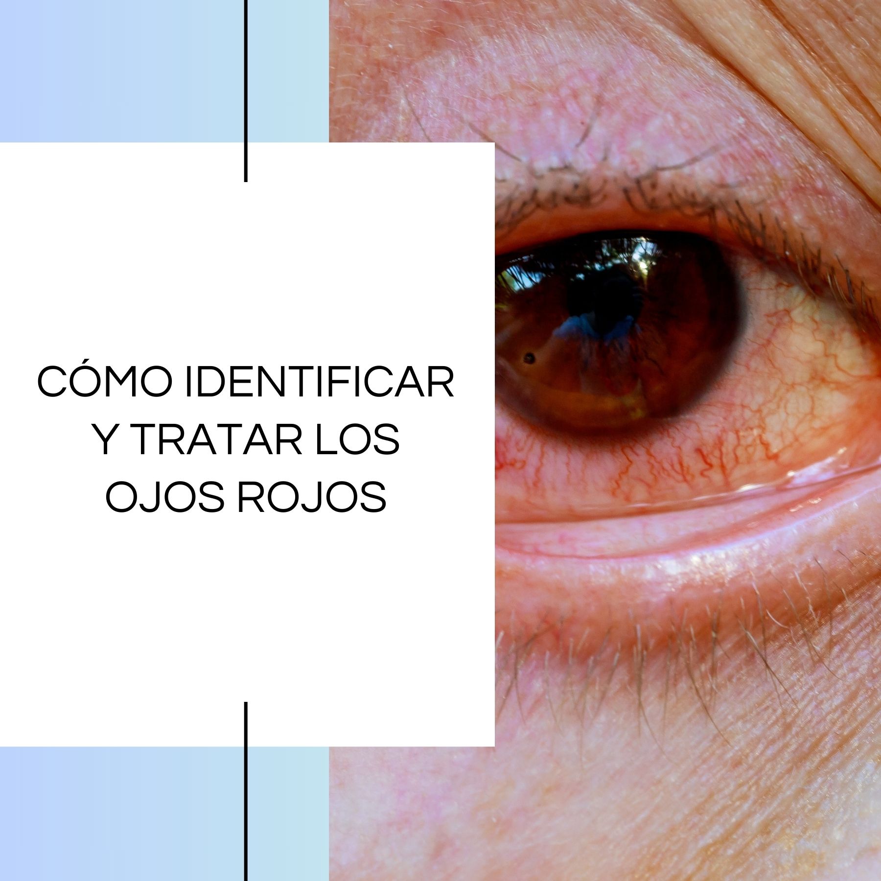 Cómo identificar y tratar los ojos rojos
